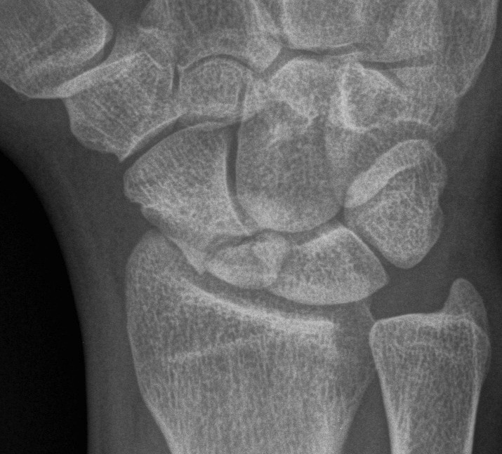 Scaphoid Proximal Pole Fracture